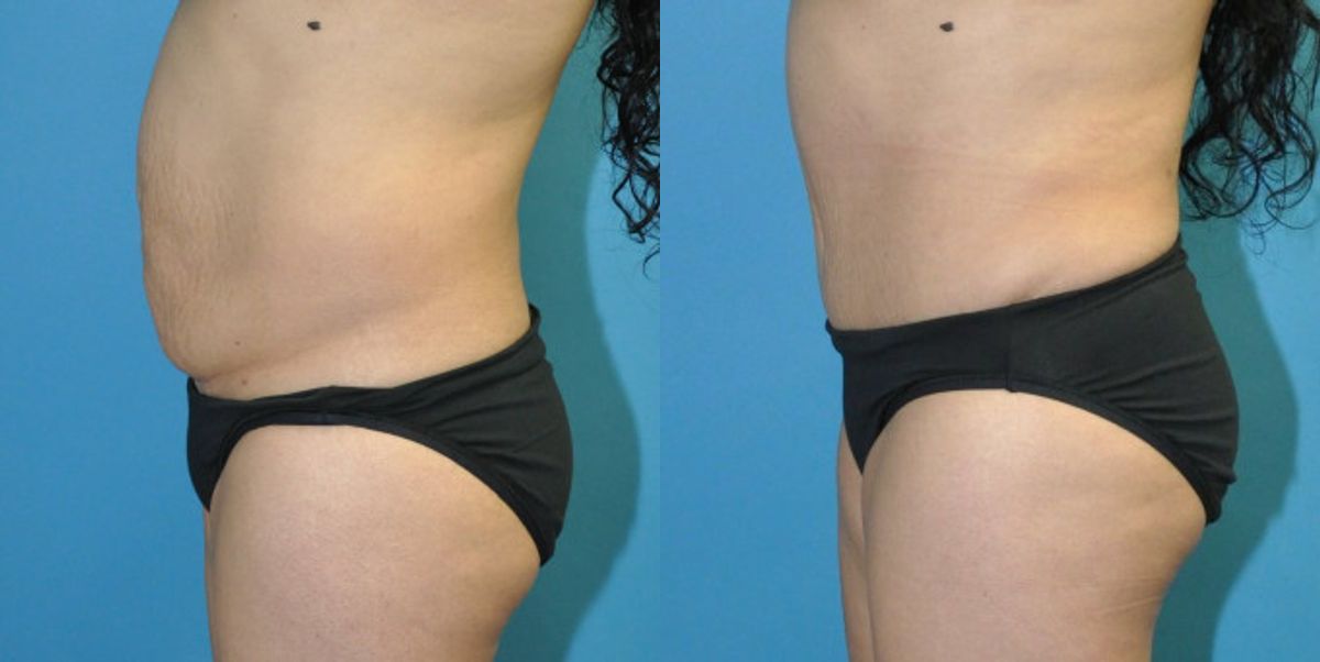 Tummy Tuck #31 - Before and After