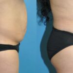 Tummy Tuck #31 - Before and After