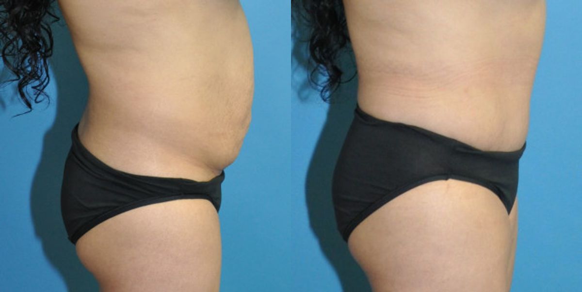 Tummy Tuck #31 - Before and After