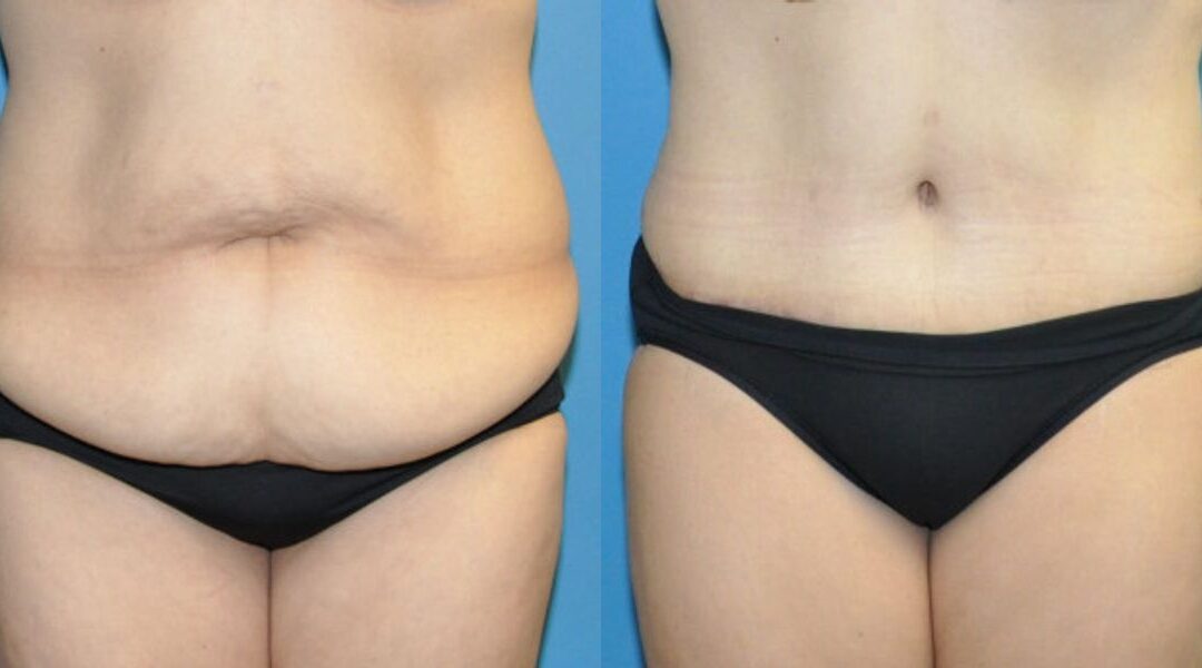 Tummy Tuck #32