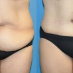 Tummy Tuck #32 - Before and After