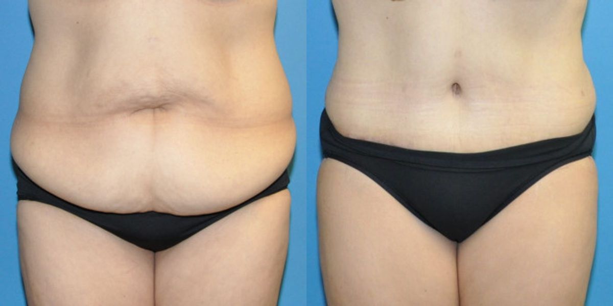 Tummy Tuck #32 - Before and After