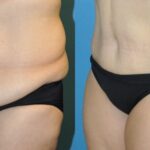 Tummy Tuck #32 - Before and After