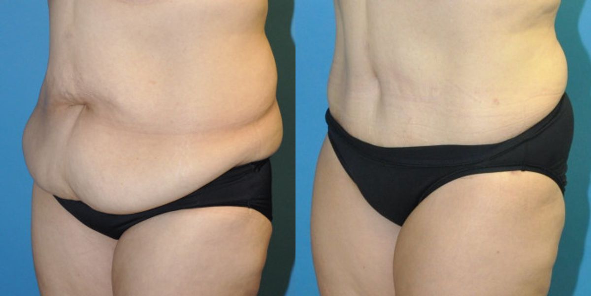 Tummy Tuck #32 - Before and After