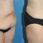 Tummy Tuck #32 - Before and After