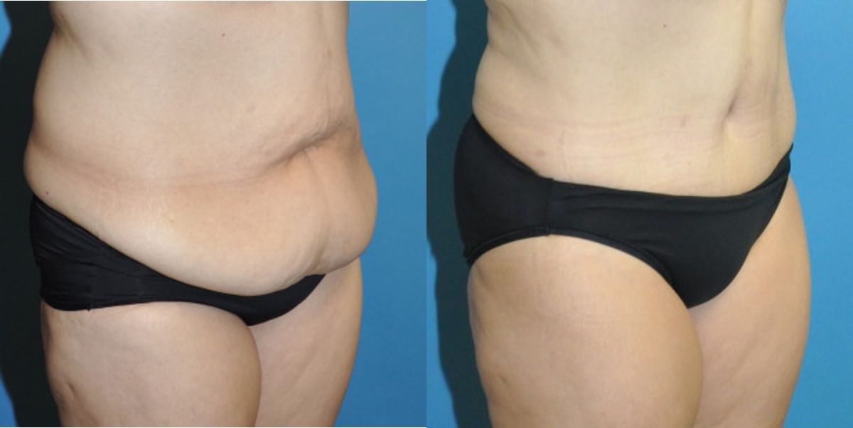 Tummy Tuck #32 - Before and After