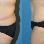 Tummy Tuck #32 - Before and After