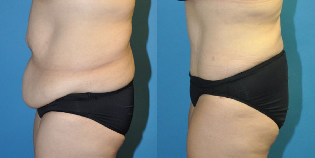 Tummy Tuck #32 - Before and After