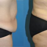 Tummy Tuck #32 - Before and After