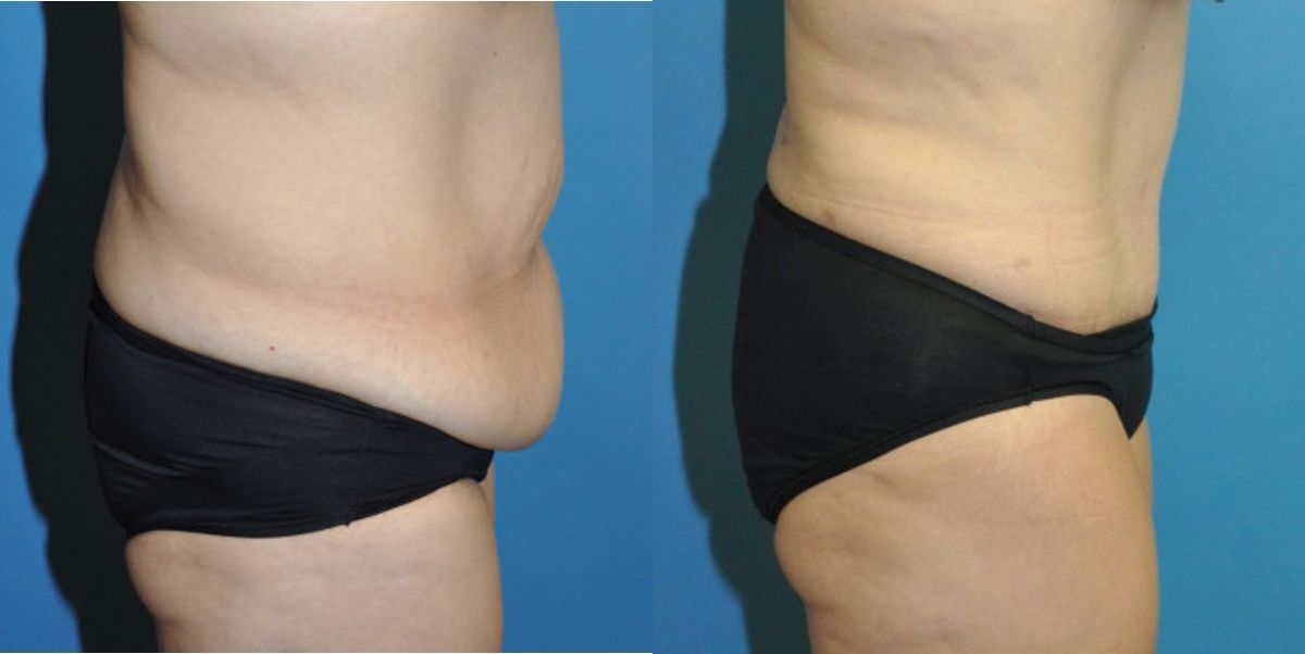 Tummy Tuck #32 - Before and After