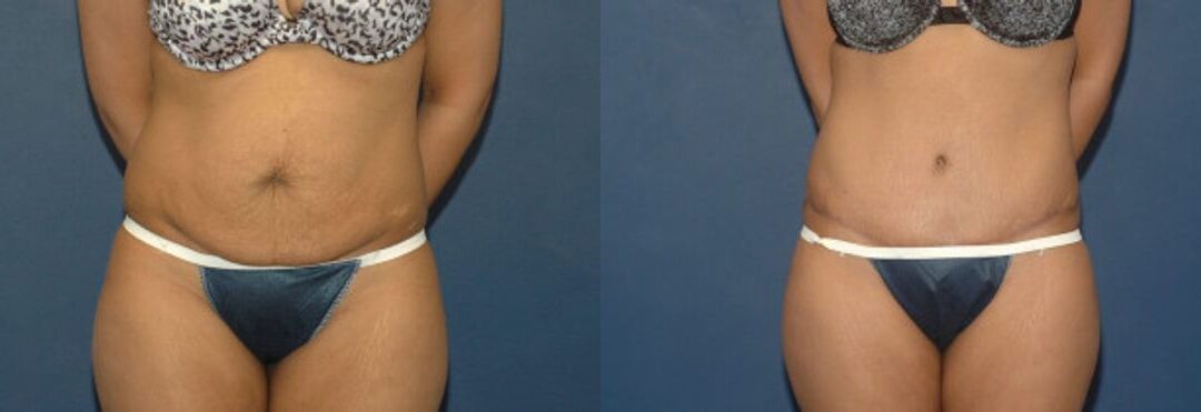 Tummy Tuck #33