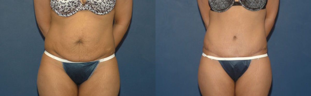 Tummy Tuck #33 - Before and After
