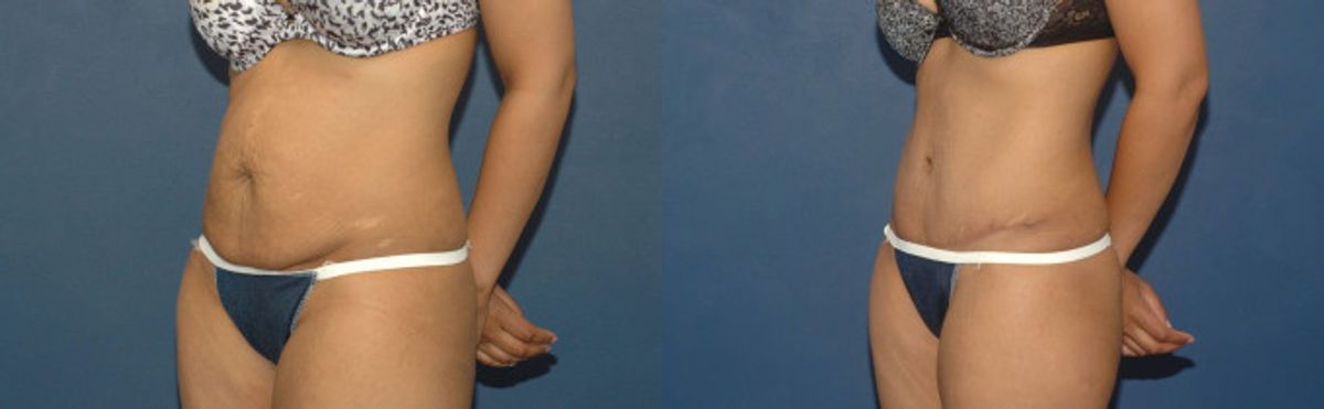 Tummy Tuck #33 - Before and After