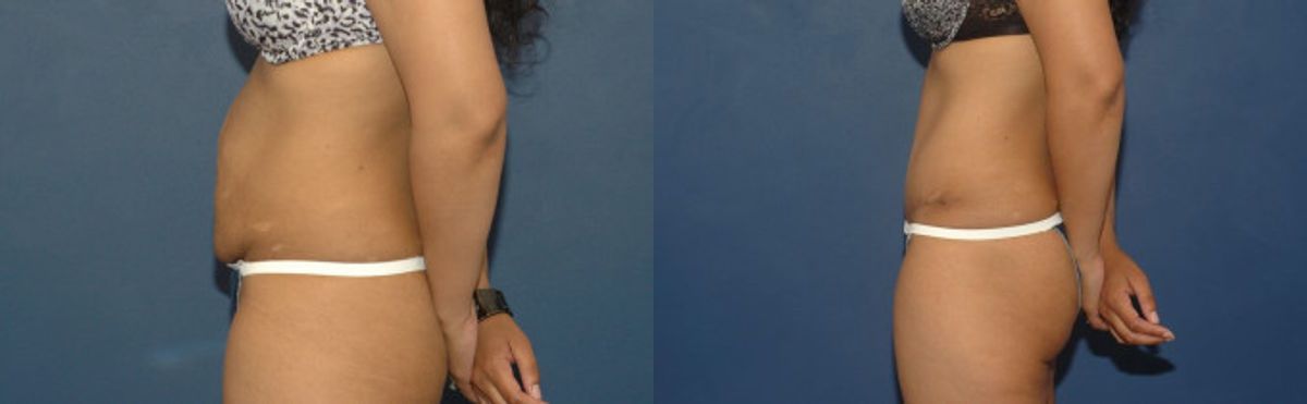 Tummy Tuck #33 - Before and After