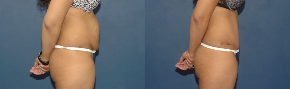 Tummy Tuck #33 - Before and After