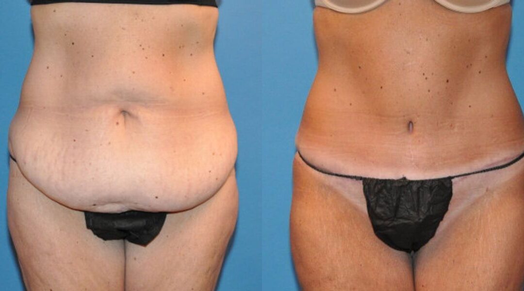 Tummy Tuck #34