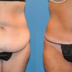 Tummy Tuck #34 - Before and After