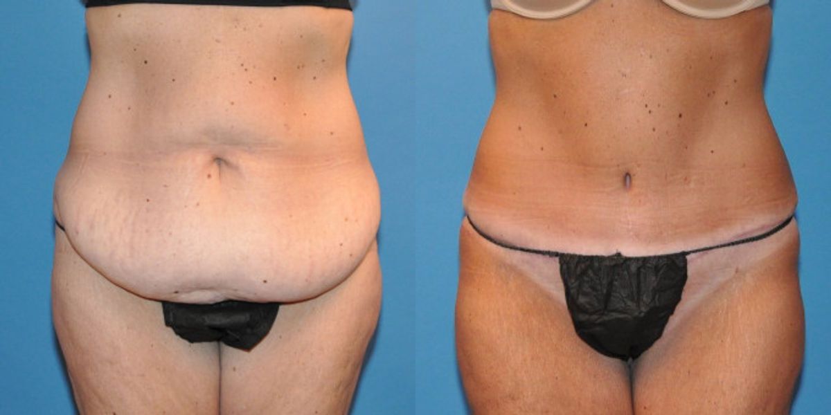 Tummy Tuck #34 - Before and After