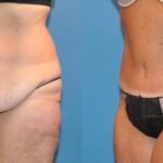 Tummy Tuck #34 - Before and After