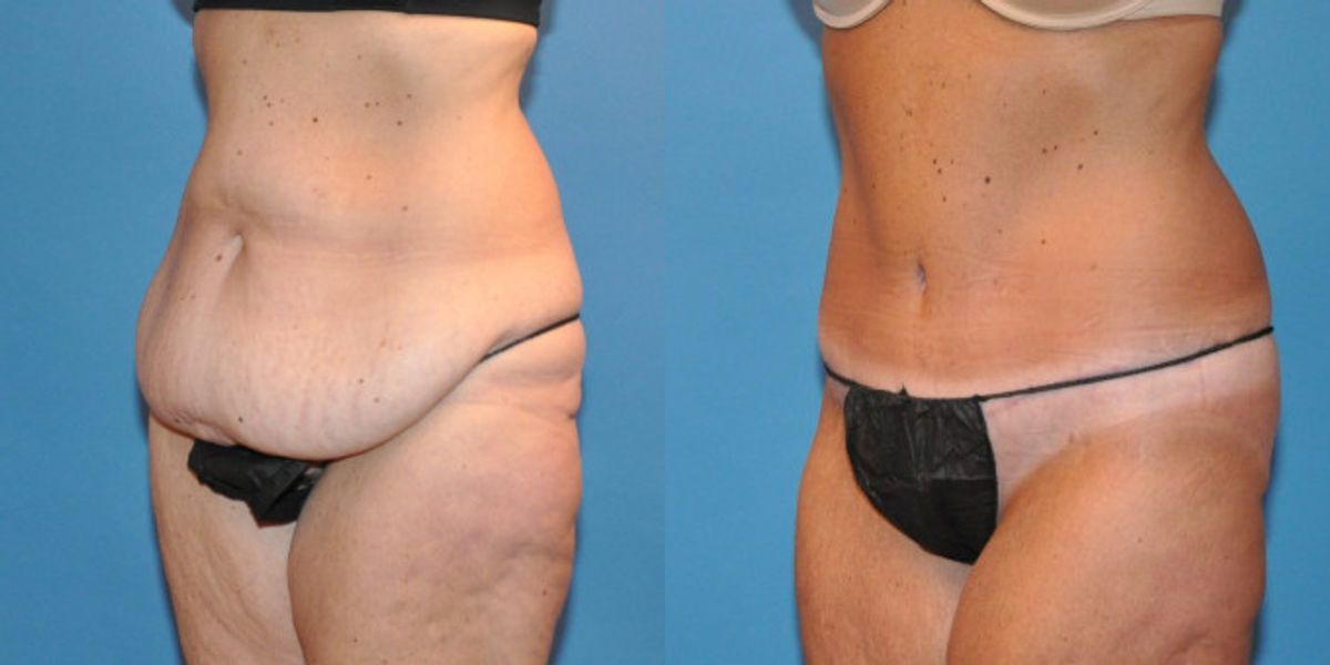 Tummy Tuck #34 - Before and After