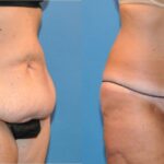 Tummy Tuck #34 - Before and After