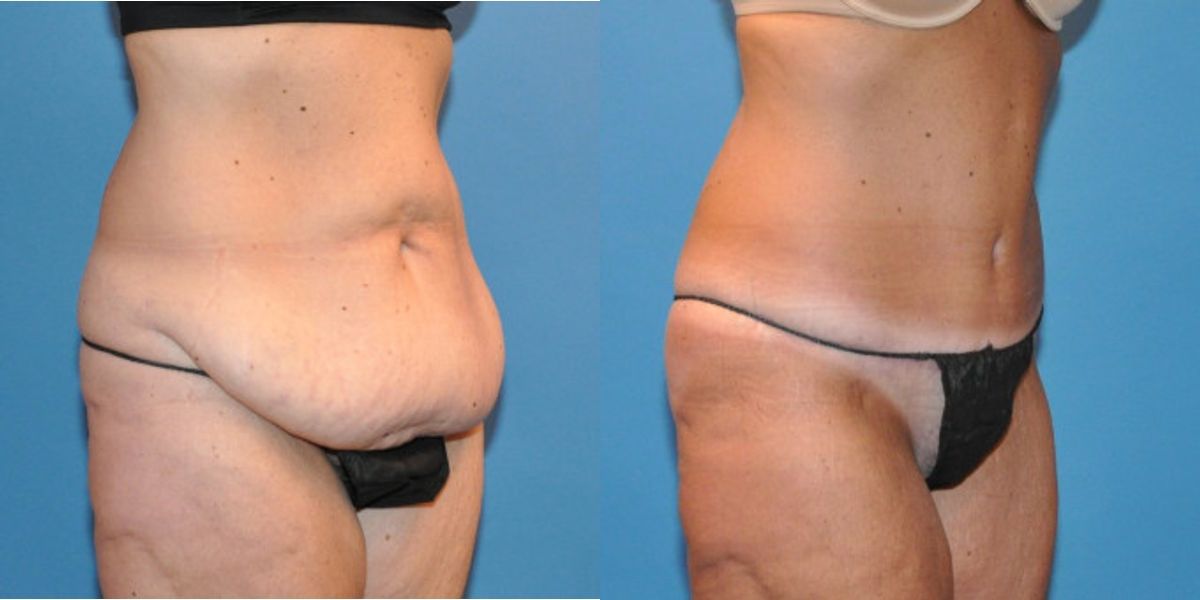 Tummy Tuck #34 - Before and After