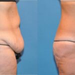 Tummy Tuck #34 - Before and After
