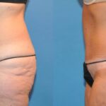Tummy Tuck #34 - Before and After