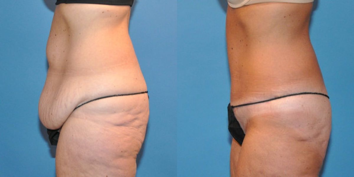 Tummy Tuck #34 - Before and After