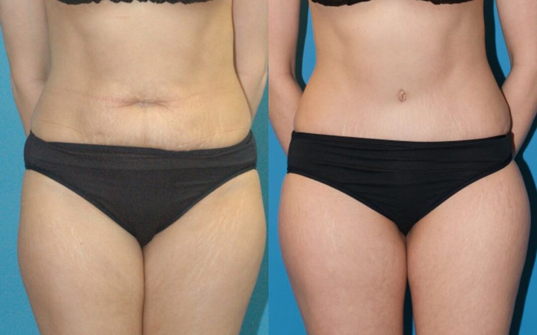 Tummy Tuck #35