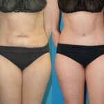 Tummy Tuck #35 - Before and After