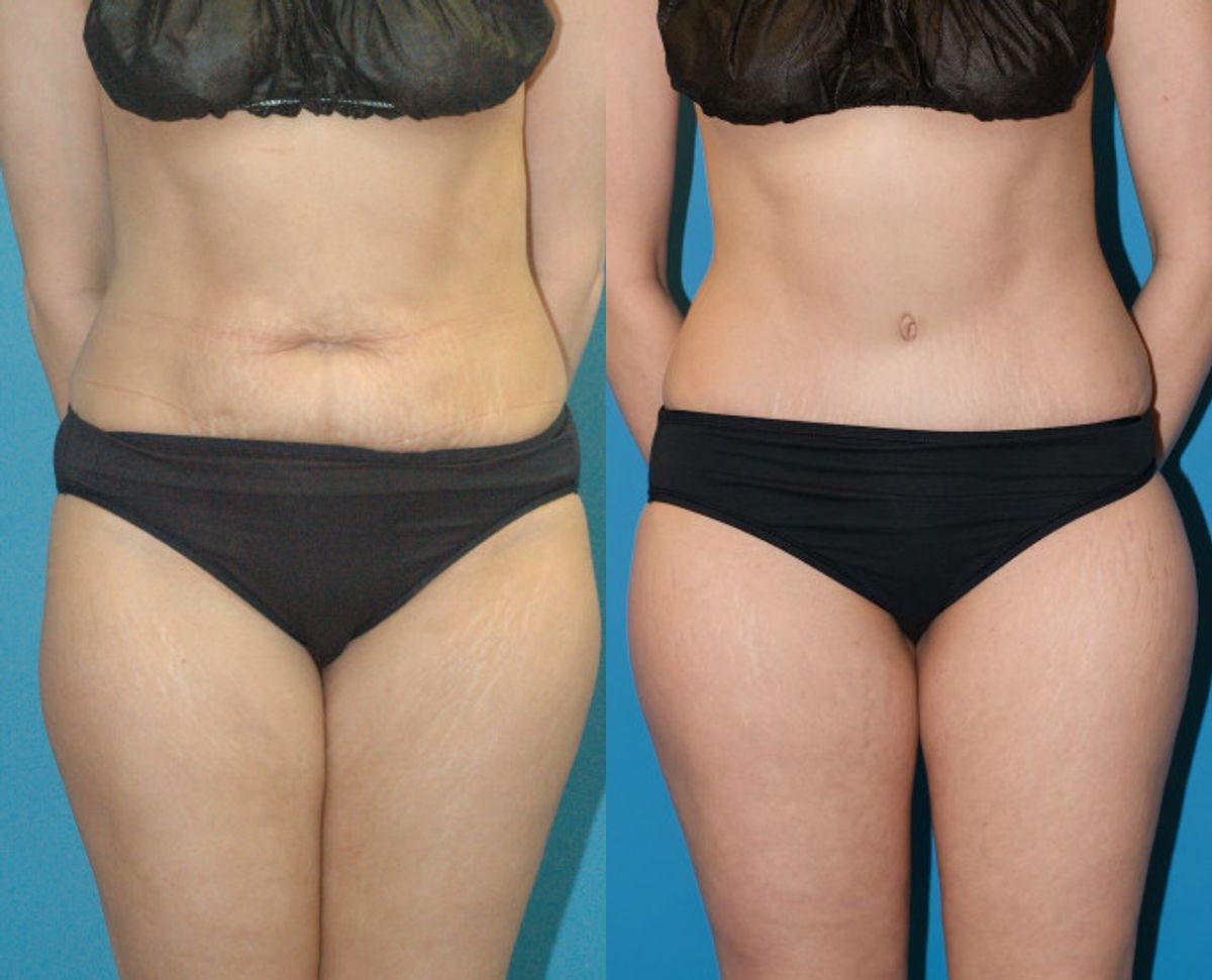 Tummy Tuck #35 - Before and After