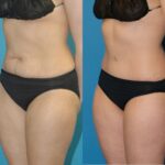 Tummy Tuck #35 - Before and After