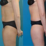 Tummy Tuck #35 - Before and After