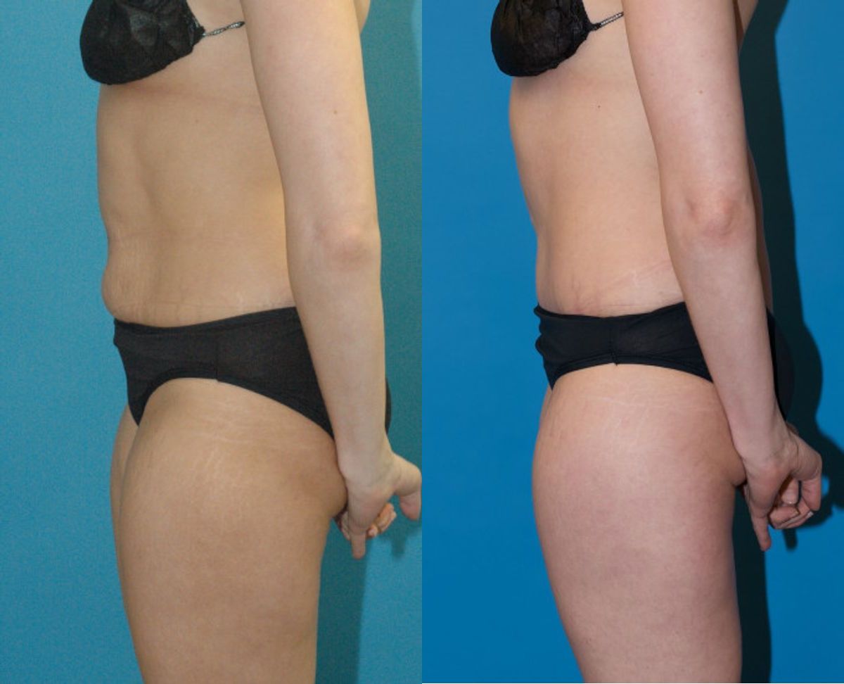Tummy Tuck #35 - Before and After
