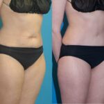 Tummy Tuck #35 - Before and After