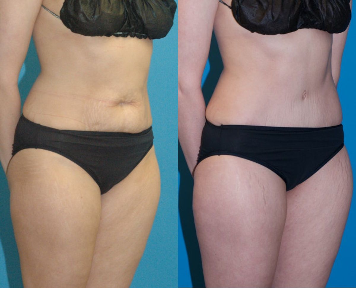 Tummy Tuck #35 - Before and After