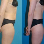 Tummy Tuck #35 - Before and After
