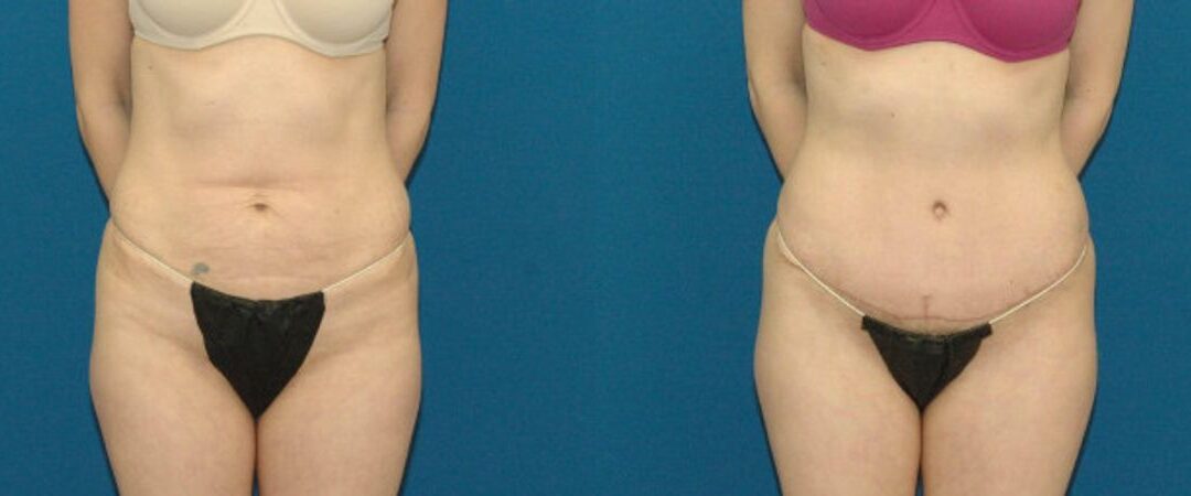 Tummy Tuck #36