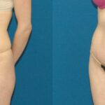 Tummy Tuck #36 - Before and After