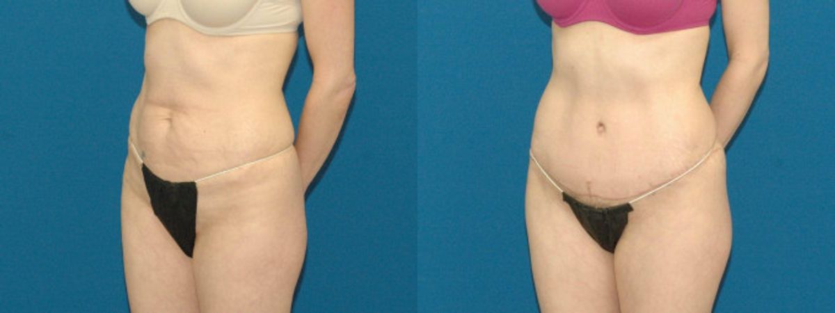 Tummy Tuck #36 - Before and After
