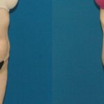 Tummy Tuck #36 - Before and After