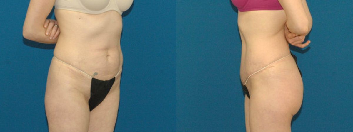 Tummy Tuck #36 - Before and After