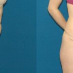 Tummy Tuck #36 - Before and After