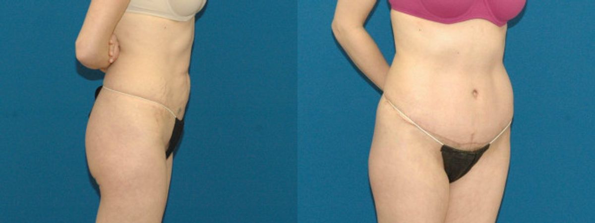 Tummy Tuck #36 - Before and After