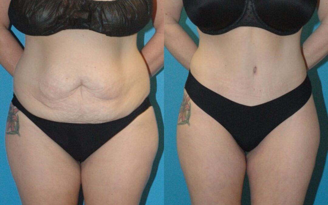 Tummy Tuck #37
