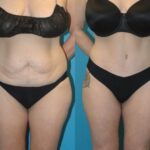 Tummy Tuck #37 - Before and After