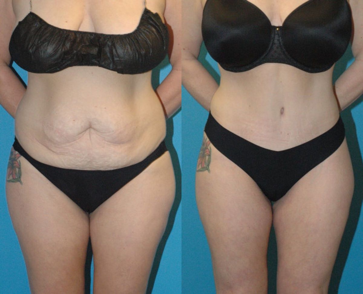Tummy Tuck #37 - Before and After