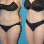 Tummy Tuck #37 - Before and After