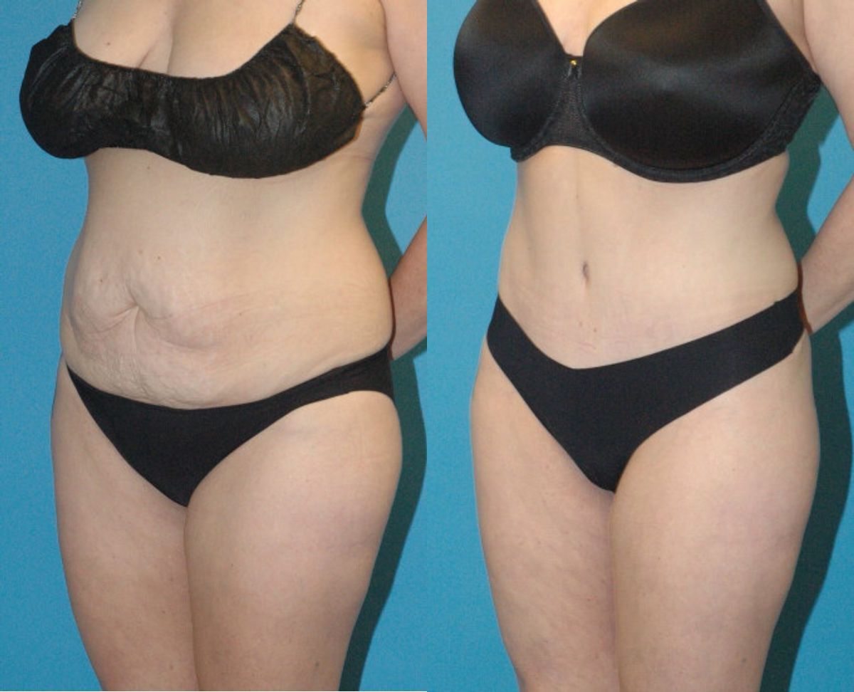 Tummy Tuck #37 - Before and After